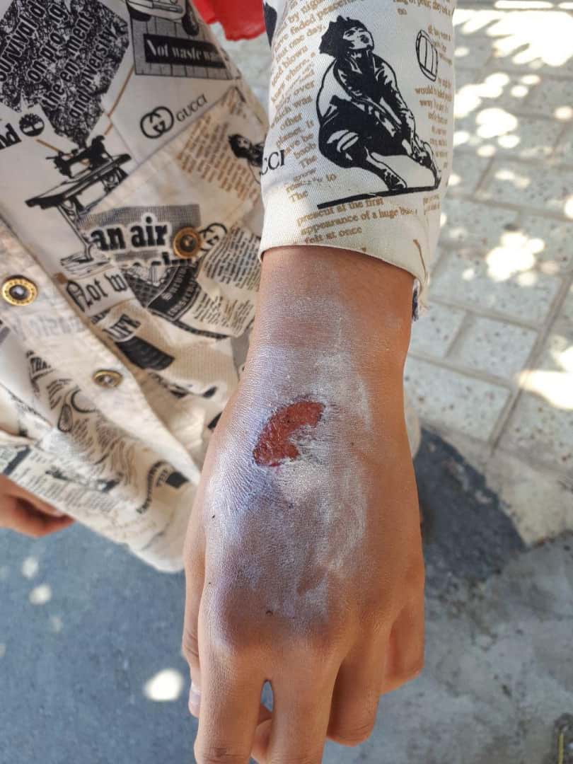 دختر ۱۳ ساله: نامادری‌ام صورت و دستم را با اتوی داغ سوزاند
